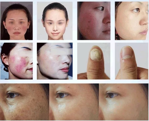 Salon Piękności Maszyna laserowa diodowa 980nm do łagodzenia bólu / leczenia naczyniowego