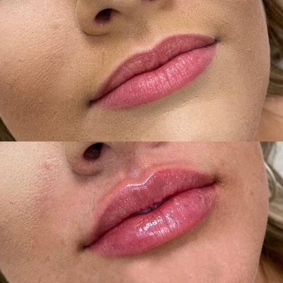 600 USD Statek 1064nm 940 808 755 Diodowy laser usunięcie włosów Lód Platyna 755 808 1064 Diodowy laser z ISO CE ISO