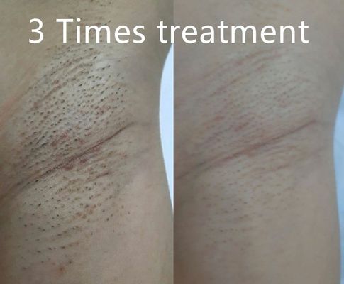 Wielofunkcyjne urządzenie do usuwania włosów laserowych diodowych obsługujące różne szerokości impulsu do długotrwałej redukcji włosów