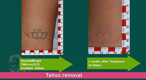 1064nm Q Switched Nd Yag Laser Picosecond Maszyna do usuwania tatuaży