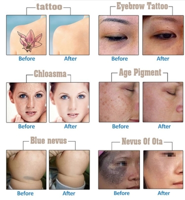 Przenośna Picosecond Laser Machine 1064nm 532nm Pico Laser Tattoo Removal Machine