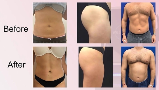 Komputer EMS Slimming Machine Profesjonalna maszyna do pielęgnacji skóry