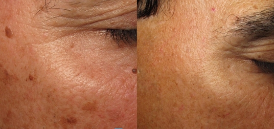Home Nd YAG Medical Laser Beauty Machine Na utratę wagi / ściśnięcie skóry