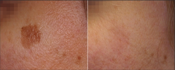 Home Nd YAG Medical Laser Beauty Machine Na utratę wagi / ściśnięcie skóry