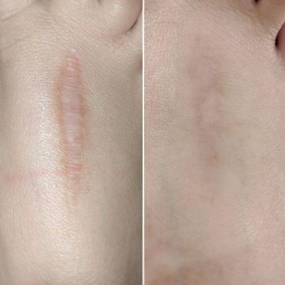 40w 60W Fractional CO2 Laser Machine For Wrinkle Removal Stretch Mark Scar Removal Tighter