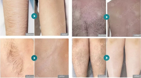 755nm 808nm 1064nm Wielofunkcyjna Maszyna Piękna Pico Nd YAG Laser Z Technologii RF