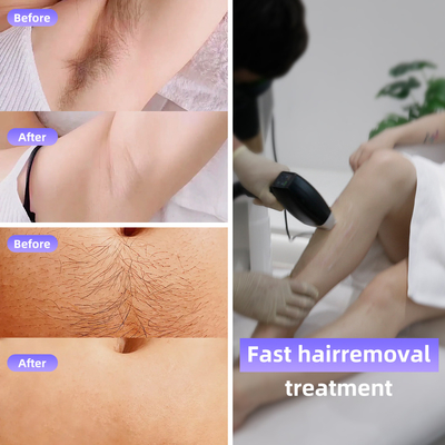 808 Diod Laser Ice Hair Removal Machine 4 Długości fali 1064nm Zmienny rozmiar plamki System Android